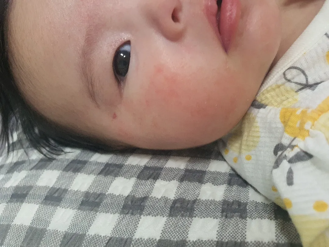 아기 피부트러블ㅜㅜ