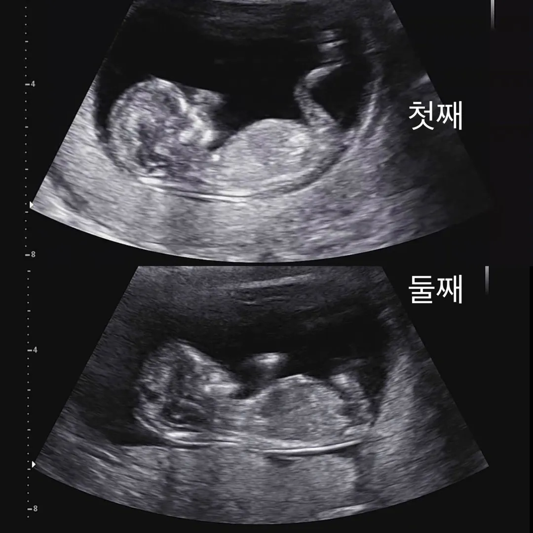 쌍둥이 각도법 봐주셔용