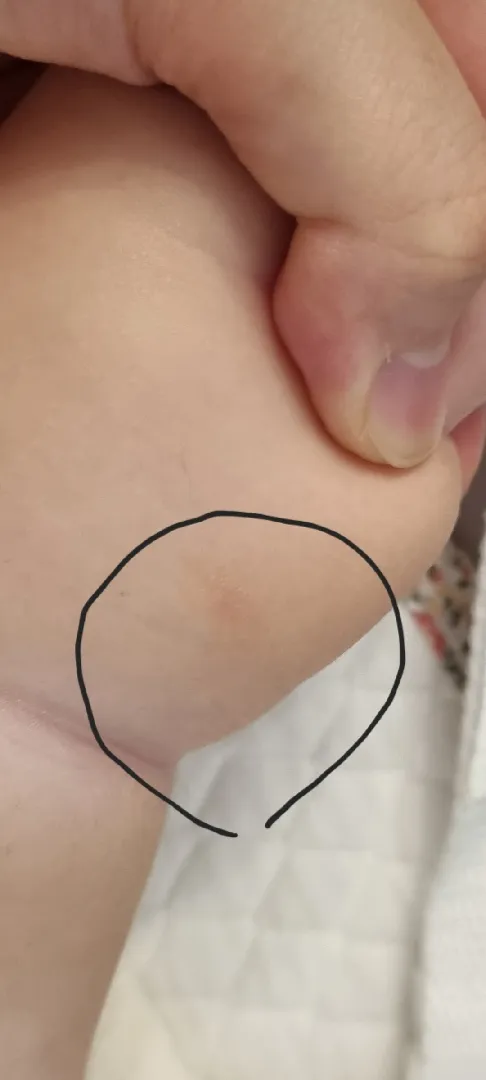 화상처럼 피부가 쭈글쭈글 발진 요런 아가있나요 ㅠㅠㅠ