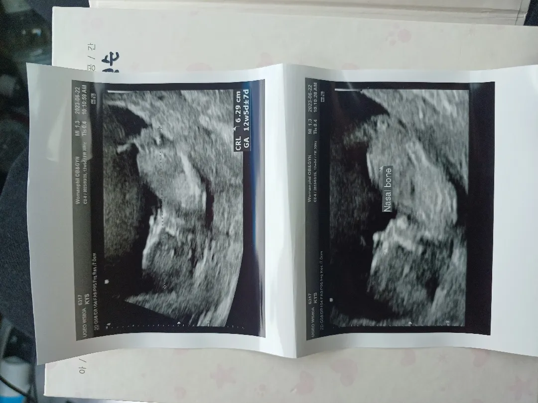 12주하고 4일 각도법좀 봐주세요