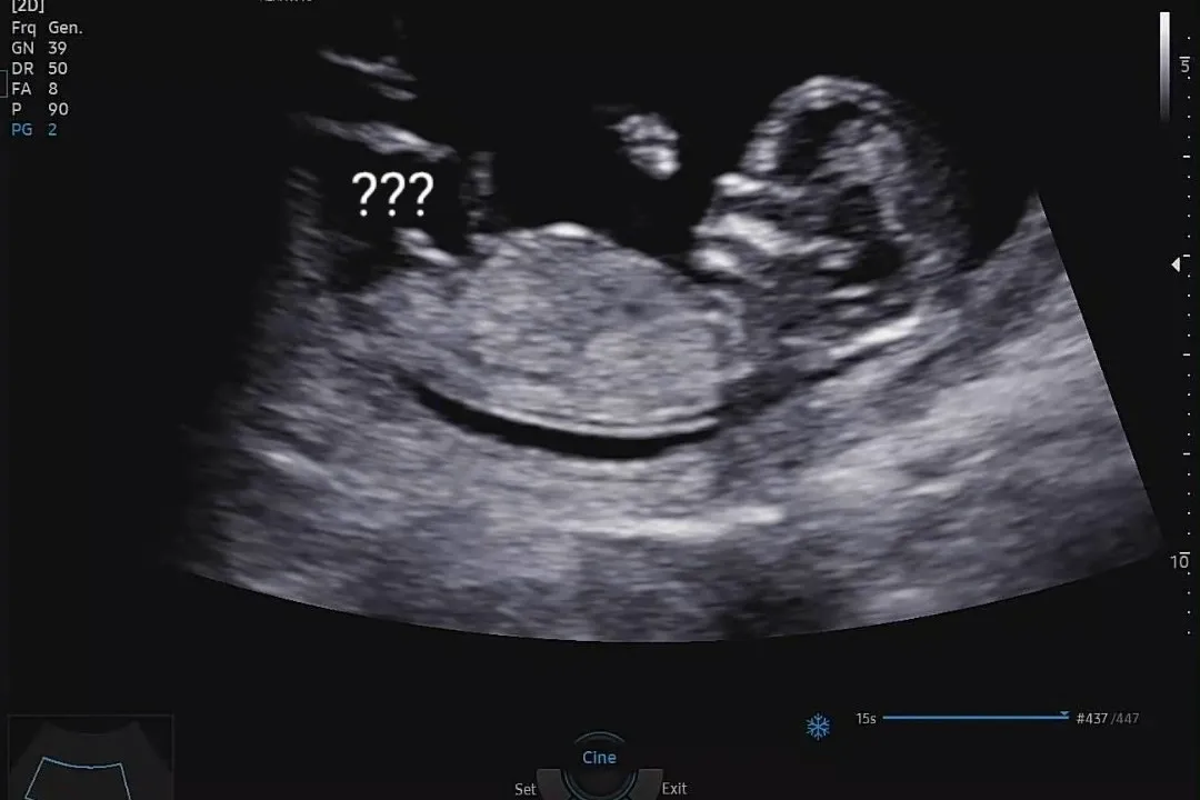 12주차 1일 성별확인이요.