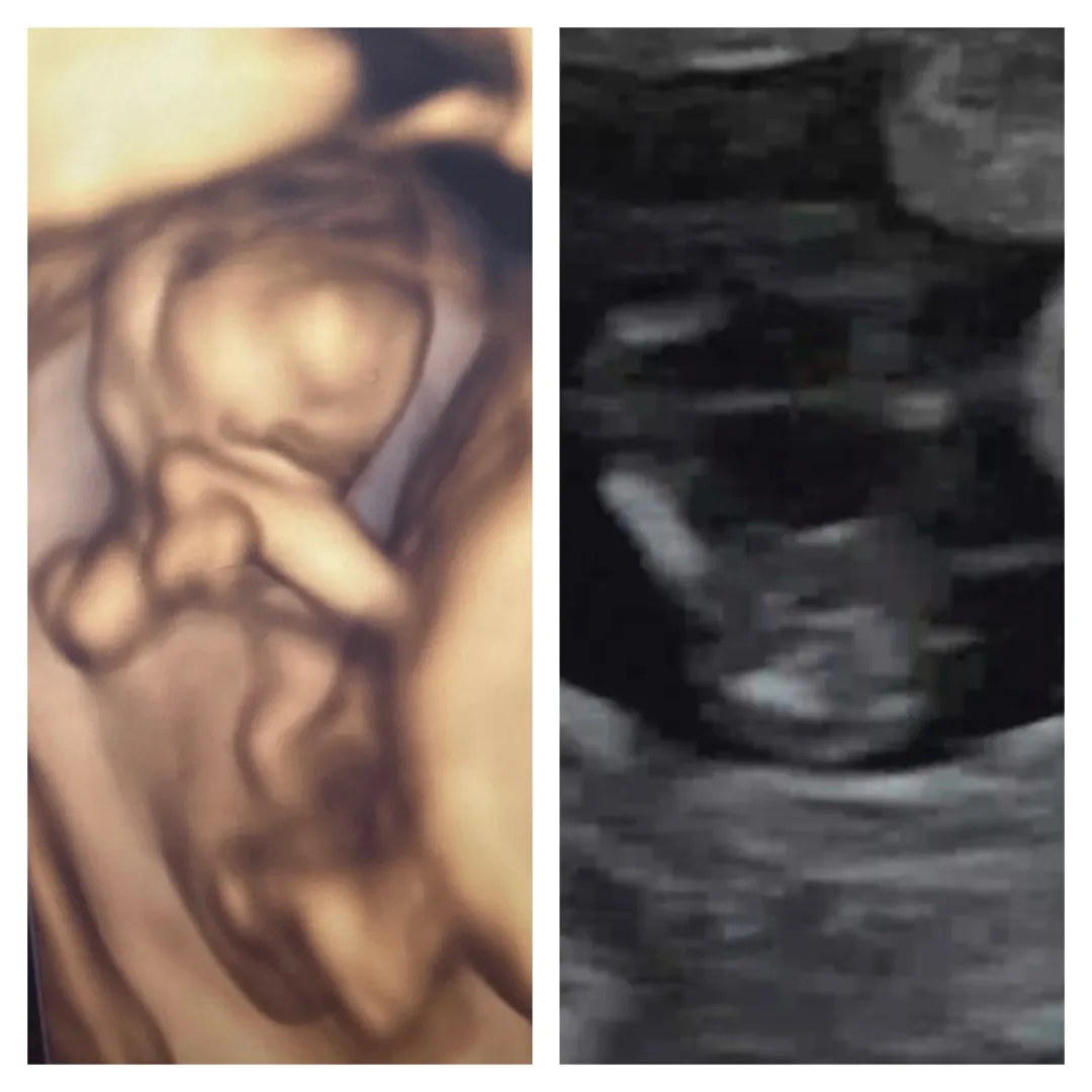 12주차 신기했던 입체초음파👶🏻