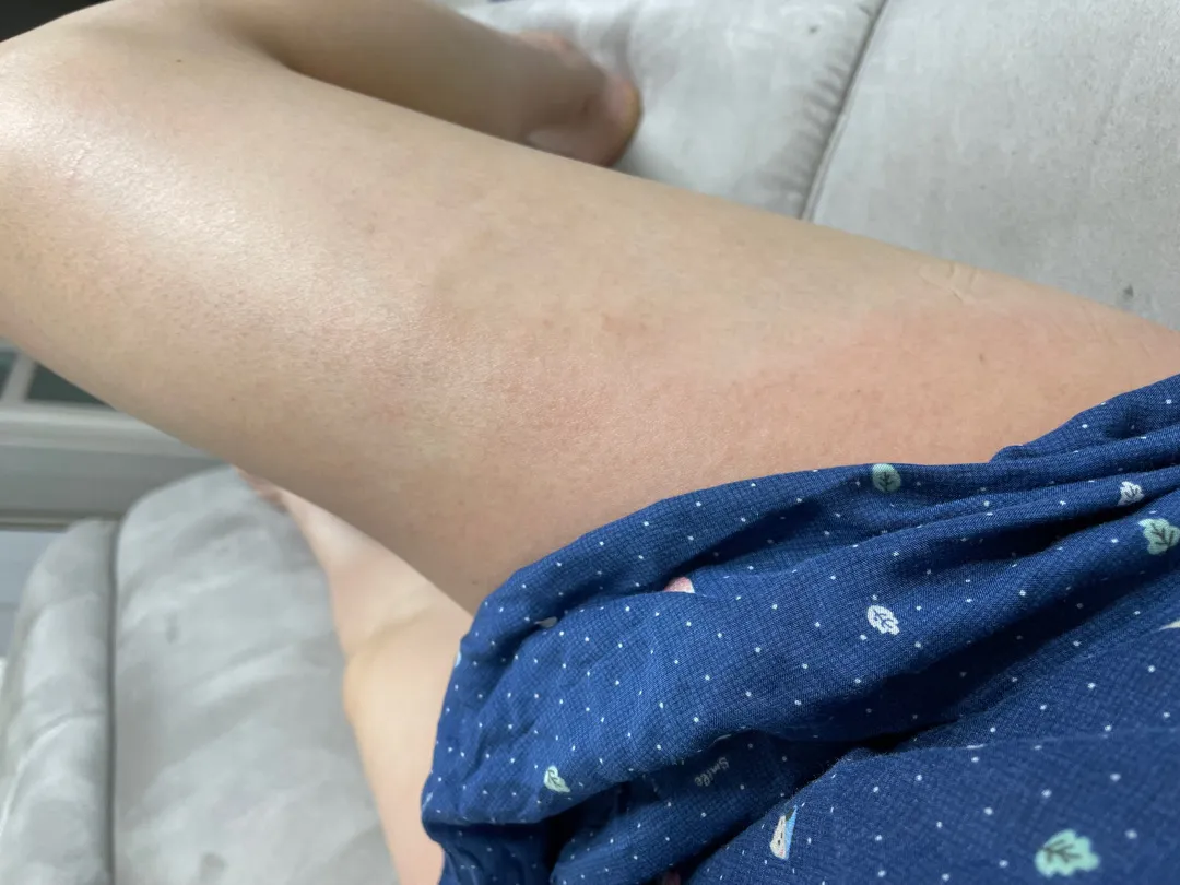 다리쪽 붉어짐
