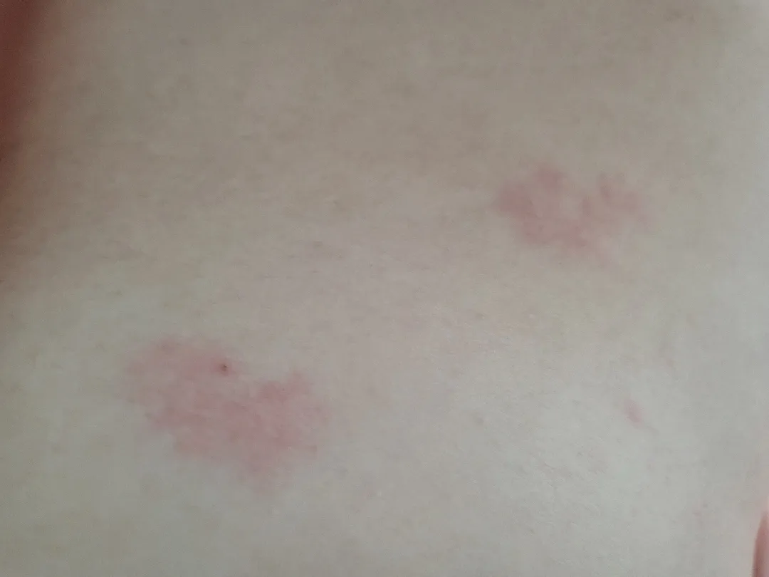 임신소양증?ㅠ간지러워 죽겠어요