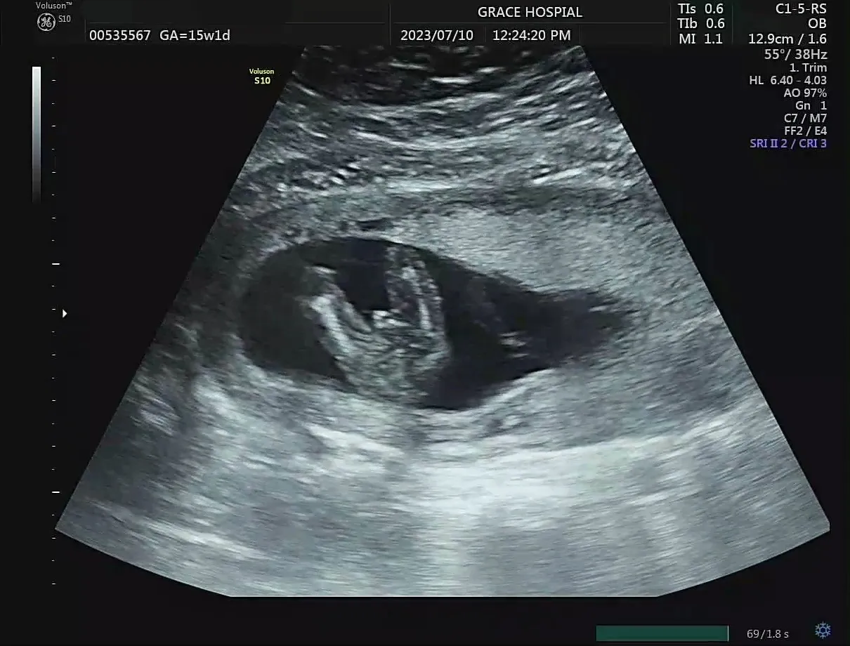 15w 1d /성별 나왔어요ㅎㅎ 조리원계약 완료!