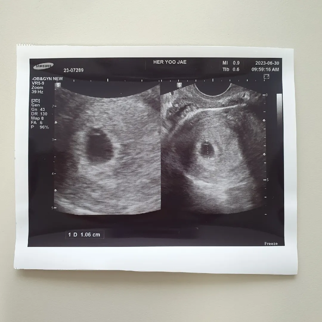 5주 2일차 아기집이랑 난황 보고 왔어요! 