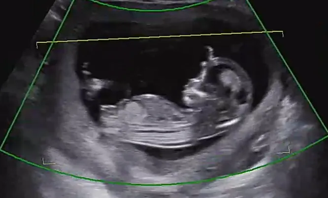 12주 4일 각도법 봐주실 수 있나요??👶✨✨
