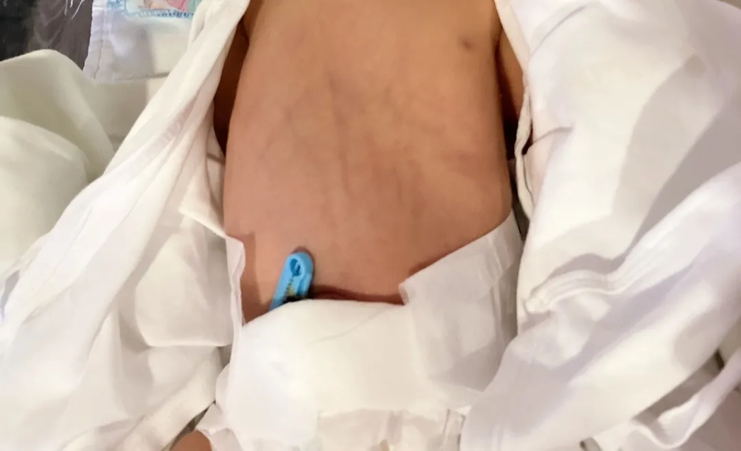 제왕절개 후 2일차인데 배 핏줄 