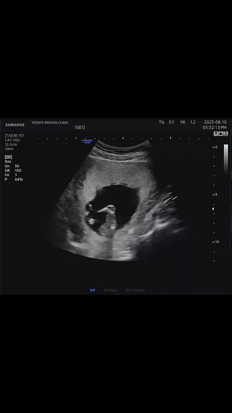 14주3일 이정도면 딸일까요 ?