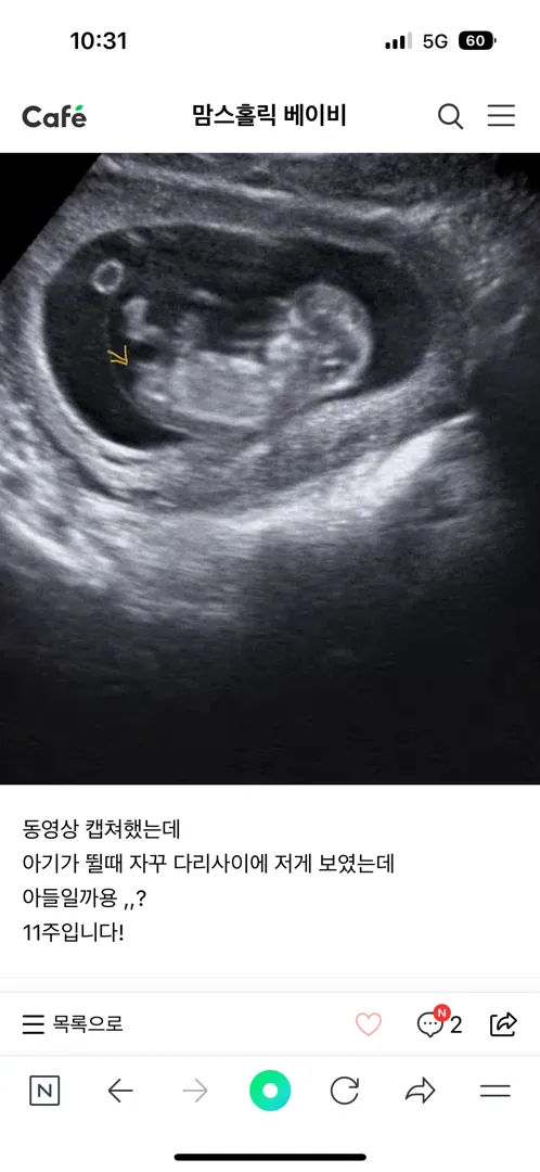 11주 초음파 딸일까요 아들일까요ㅎㅎ