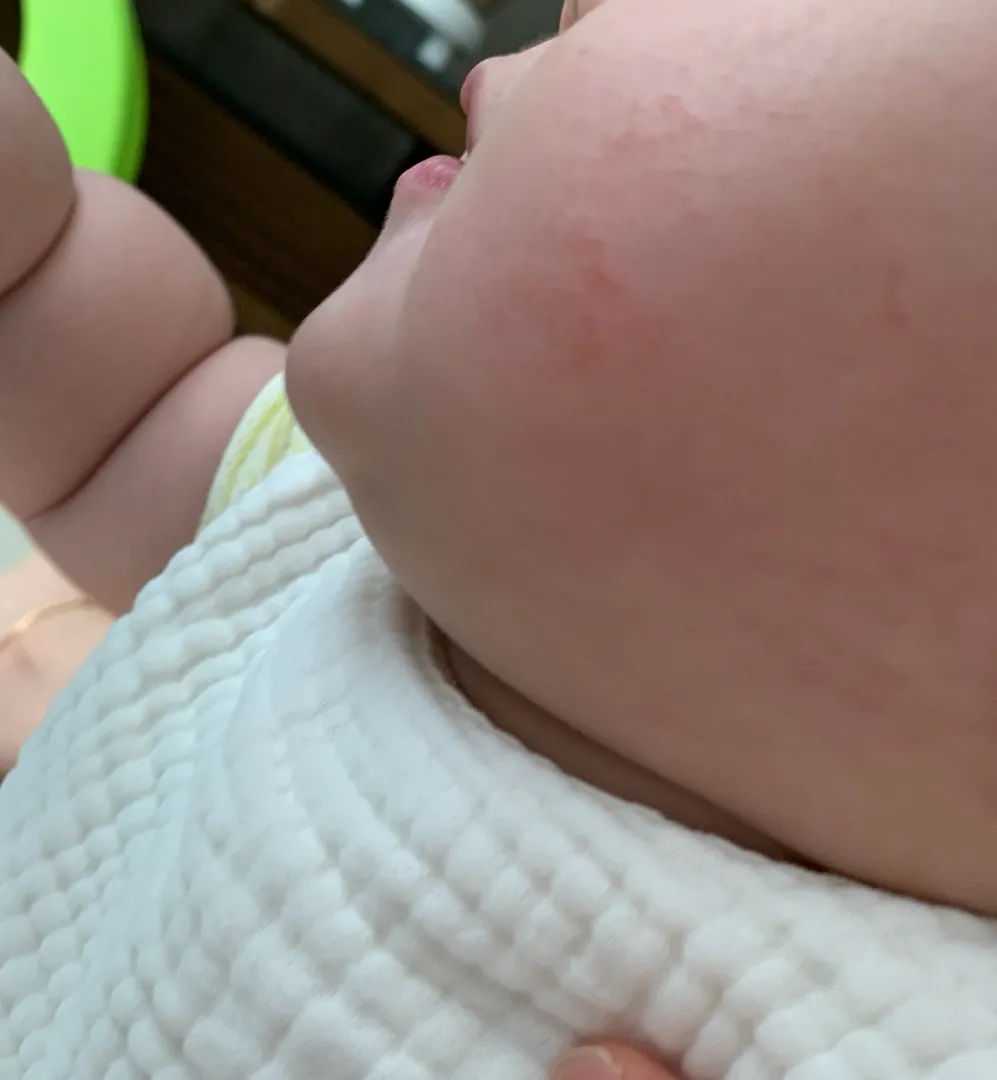 아기 얼굴 습진?