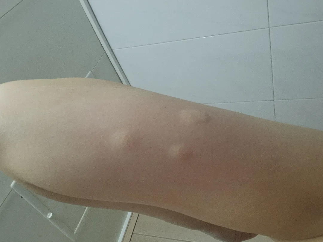 혹시 피부에 이런거 생기신분 계신가요
