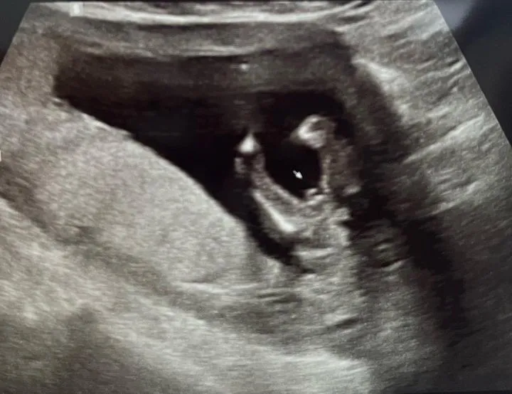 14w5d