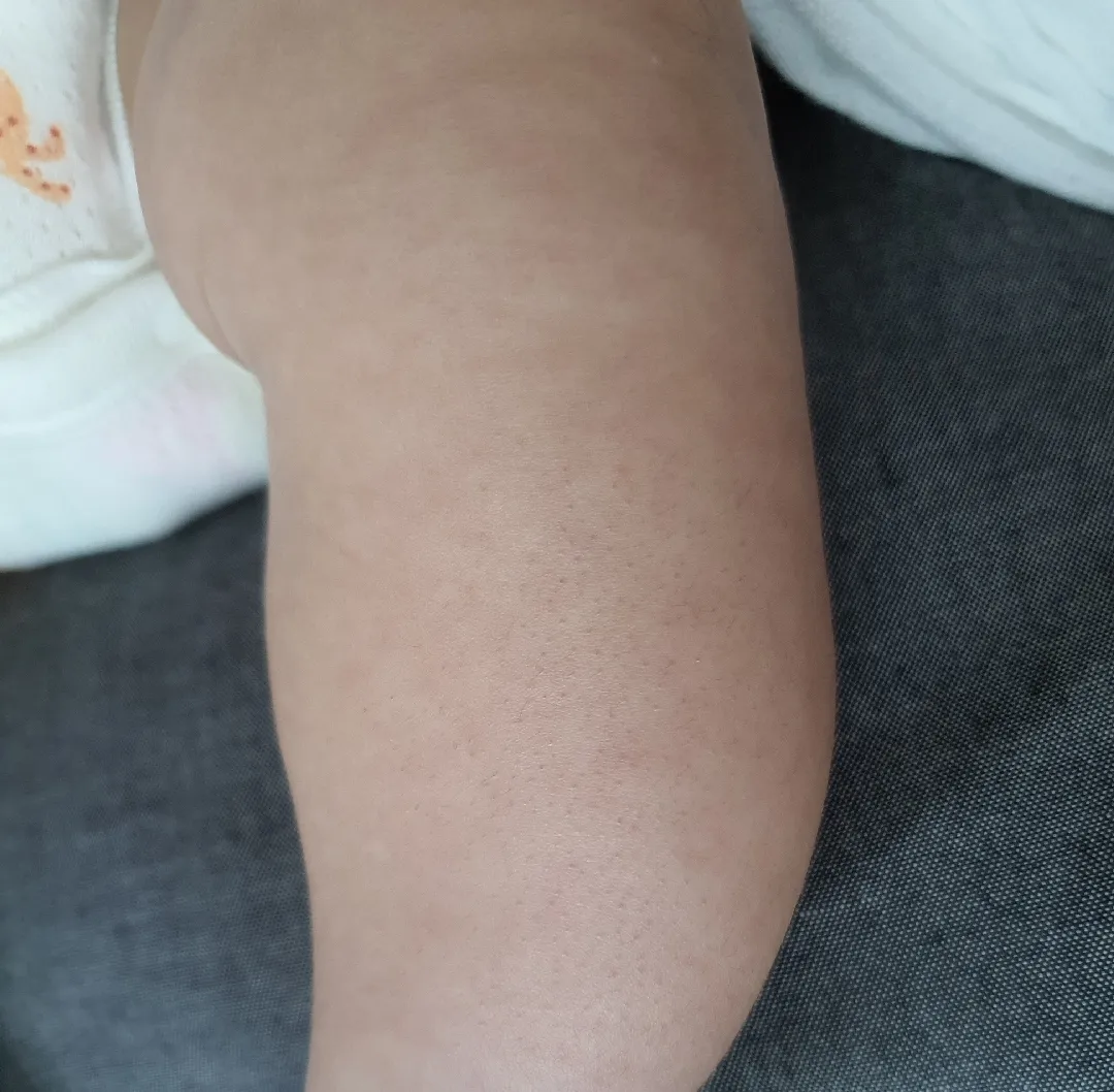 아기피부 닭살?