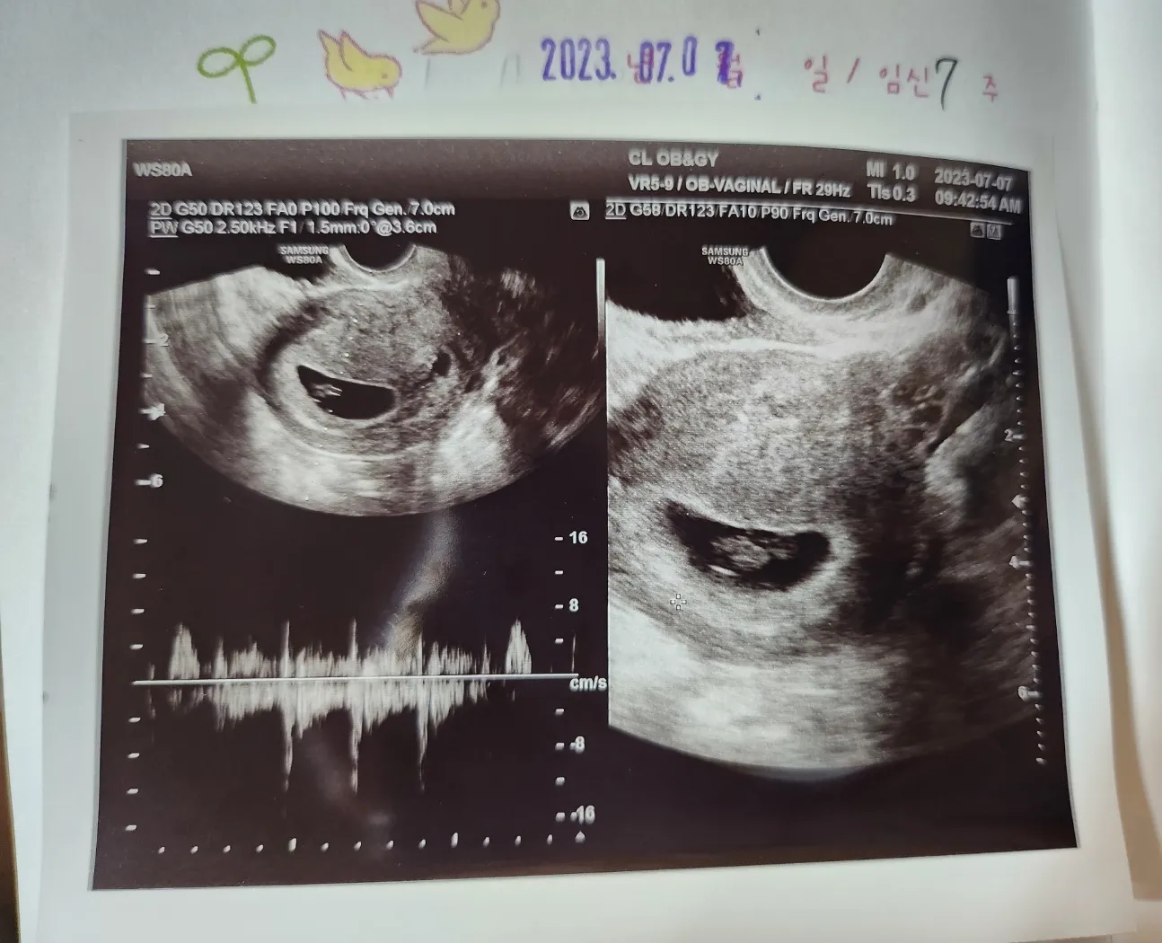 무증상에 6주차 갈색냉..현재7주차