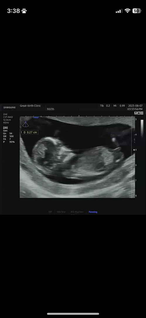 14주차 초음파 고수님들도와주세요ㅠㅠ