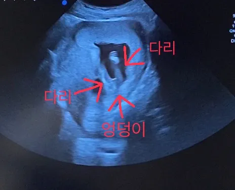 14주 엉덩이 사진이에요!!성별 너무 궁굼해요!!