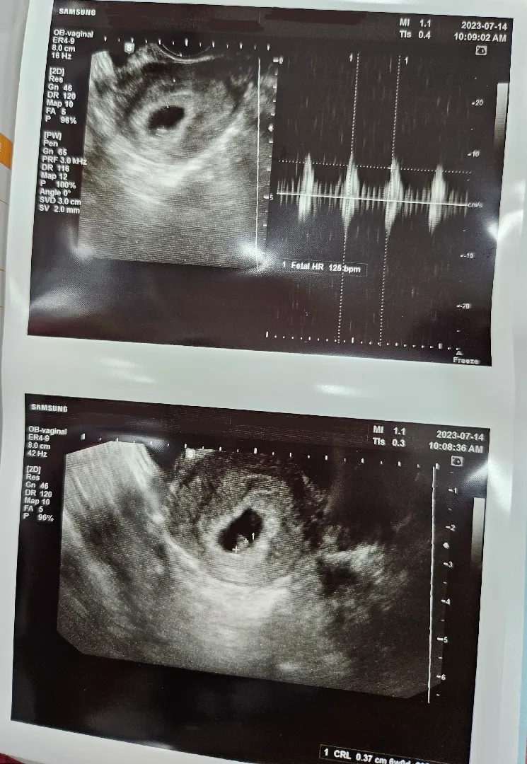 일주일가량 지속된 출혈, 그리고 아기 심장소리👶