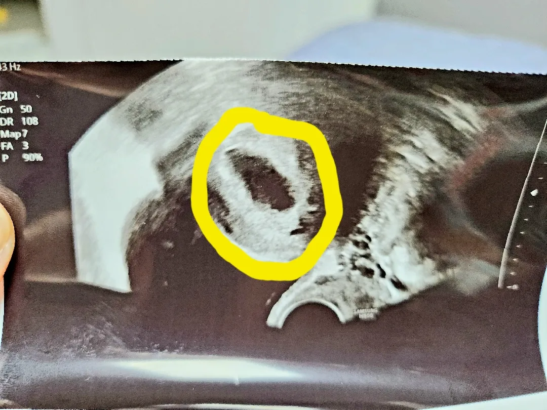 어제 아기집보고왔는데...