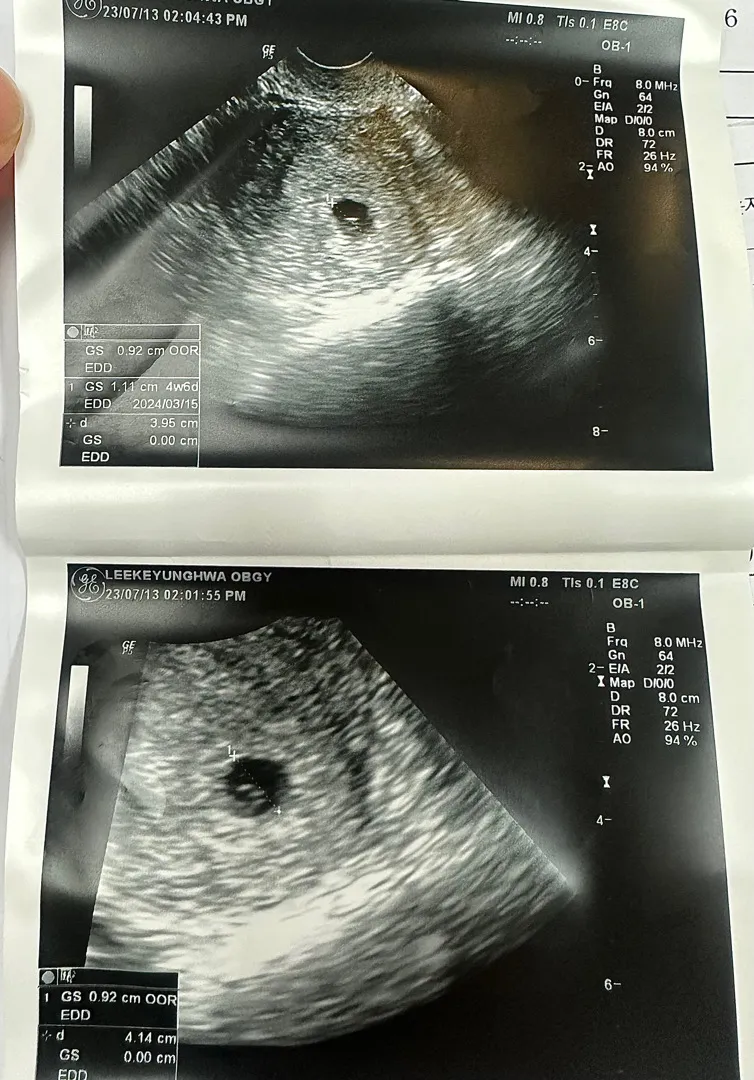 5주6일차 초음파 봐주세용!!