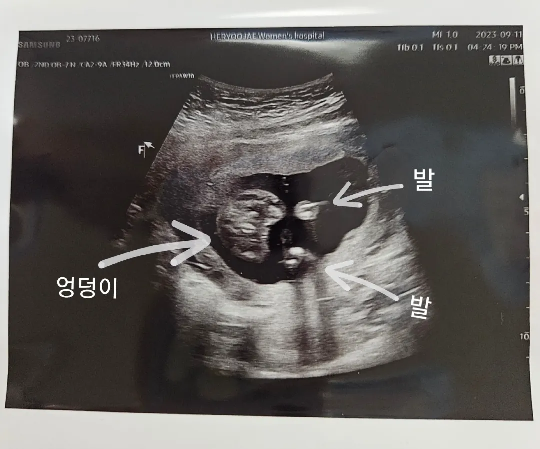 16주 3일 초음파