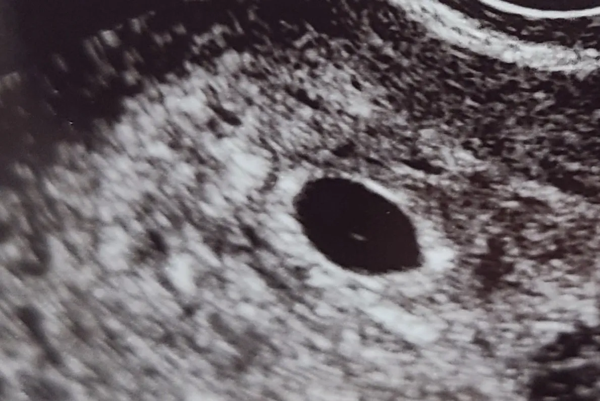 딱 5주된 텐테니예요🙆