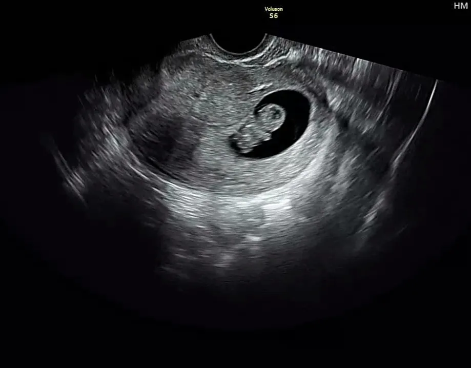 8주5일 젤리곰보고와써여