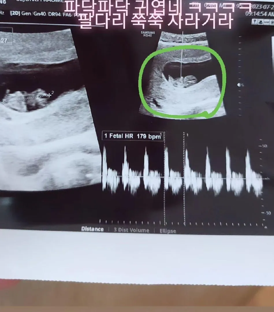 8주4일 배촘파 뭔가 선명히안보여요ㅜ 11주에 질촘파 해도 되겠죠?