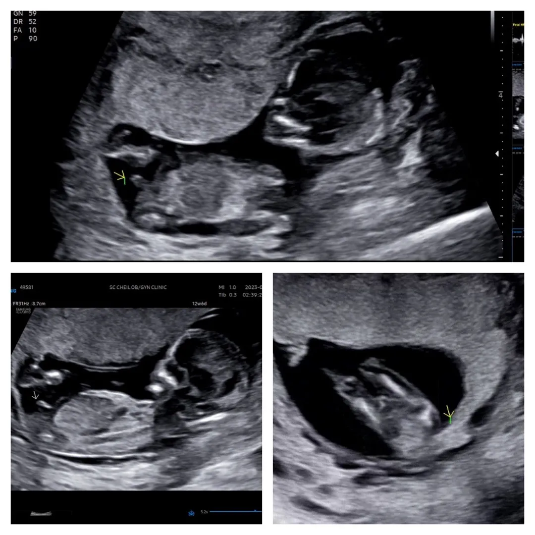 12w6d 촘판데..