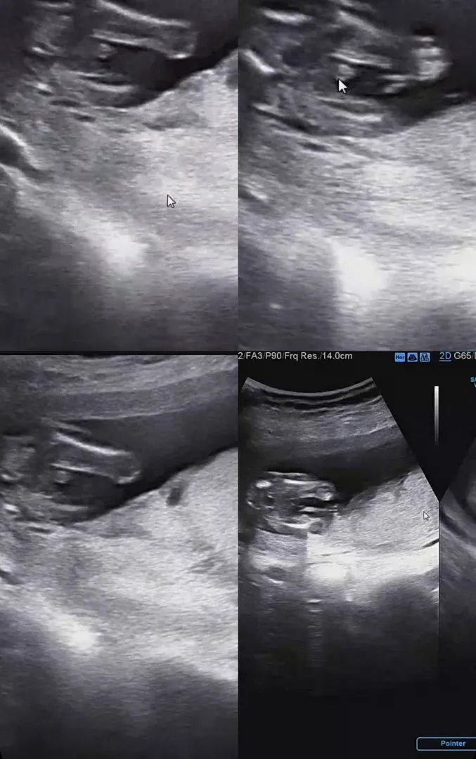 15주 3일 초음파 성별은? !