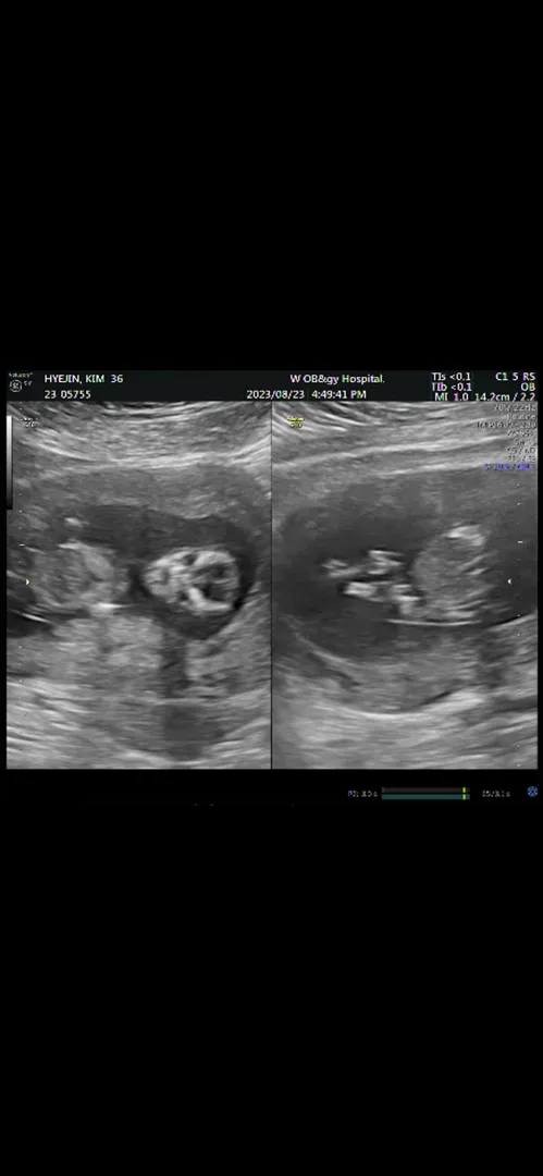12주3일차 니프티검사겸 한방이 확인👶🏻😍