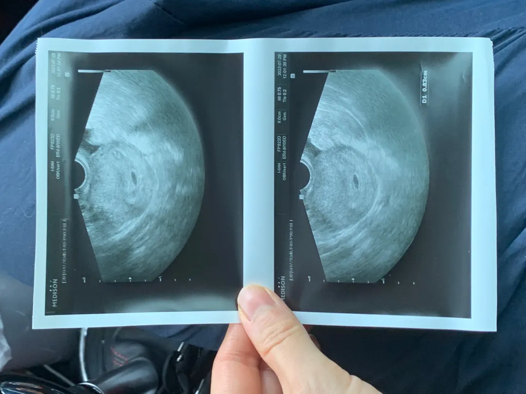 5주 2일차 🤍아기집 보고왔어요