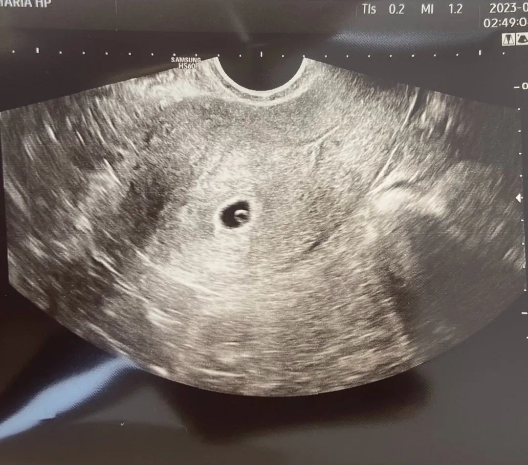 오늘 아기집 봤어요!!(5주2일)