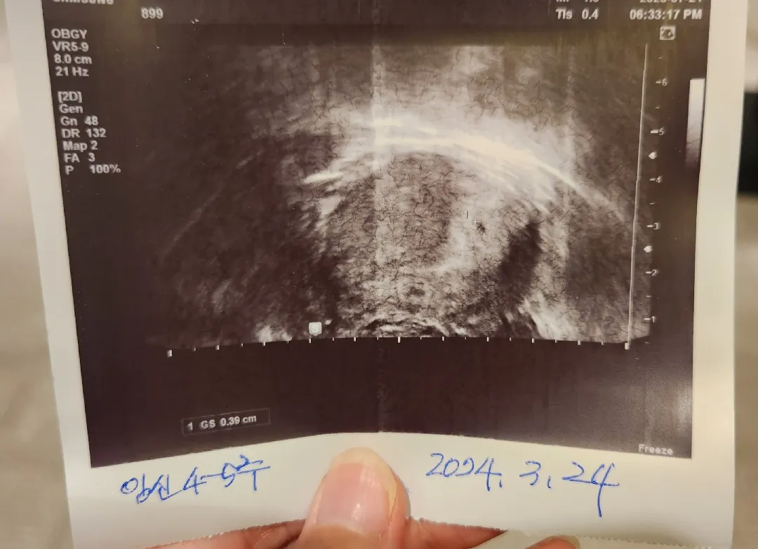 임신사실 알게된 이틀 뒤 코로나 확진