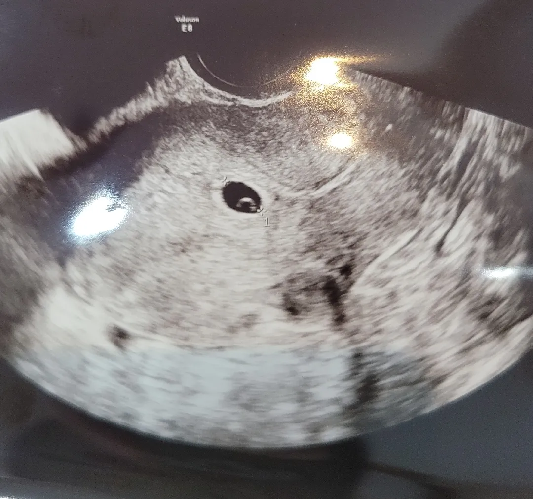 오늘 아기집 보고 왔어요ㅎㅎ