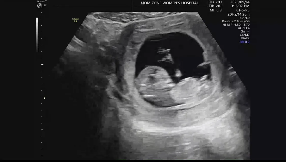 12주 성별 궁금해요ㅠㅠㅠ