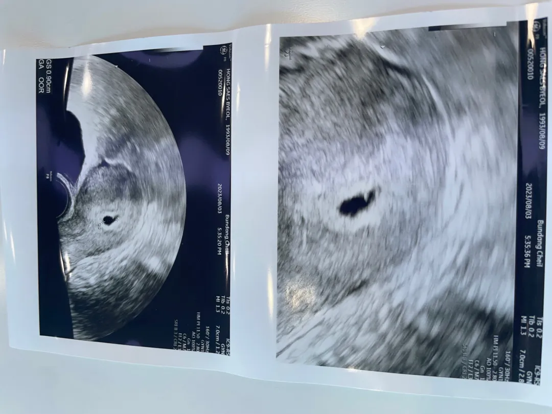 초음파 보고왔어요! 5주 0일