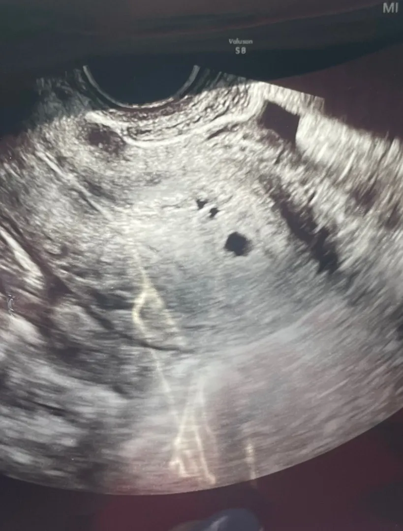 혹시 쌍둥이일까요(초음파사진첨부)