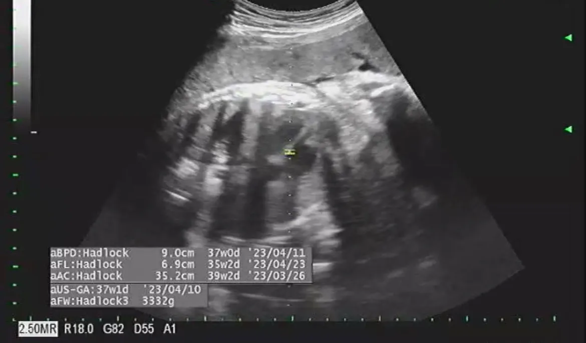 36주1일차에 아기 몸무게 3.3kg ^^^^^
