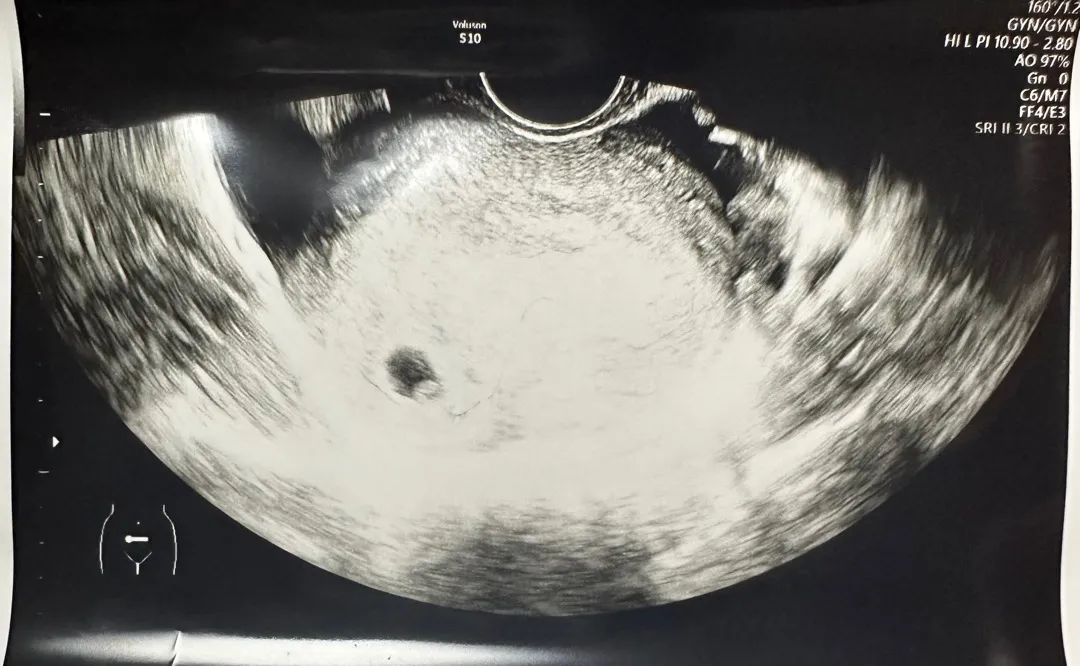 자궁각임신이였던 분 계신가요??
