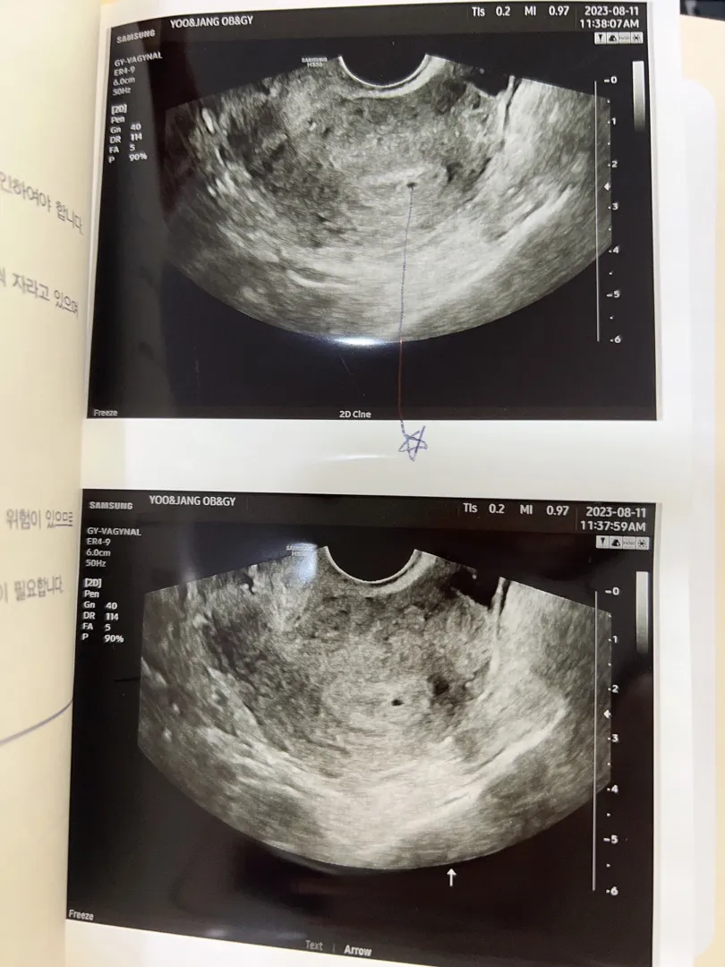 4주 4일차 첫 아기집 확인