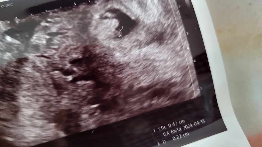 쌍둥이 중 한 아기가 너무 작아요ㅠㅠ