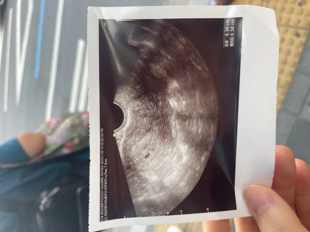 4주4일차 진짜 쪼만한 아기집 확인했어요