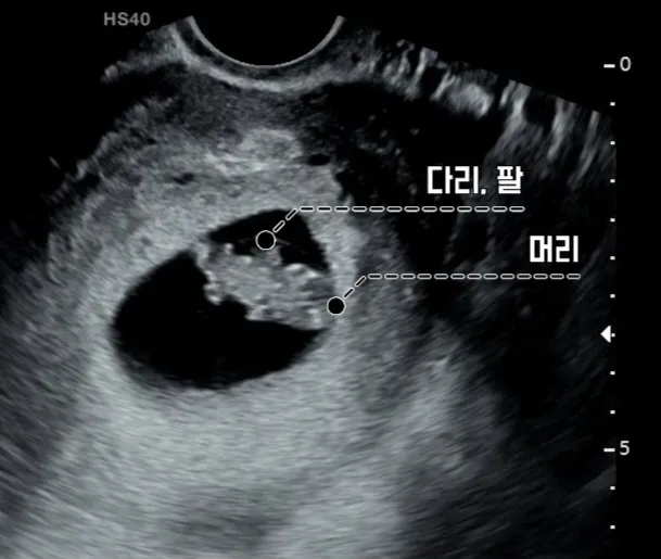 8주차 초음파 보고왔어요!