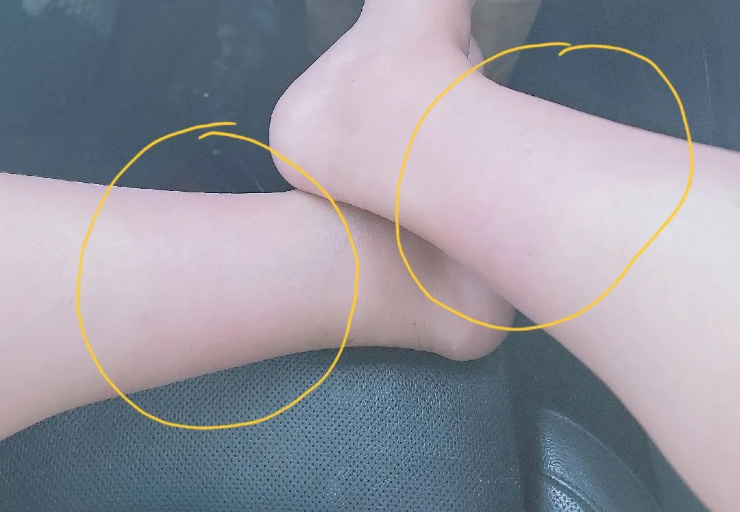 임신 착색증? 하지정맥류? 답답한 마음에...ㅠㅠ