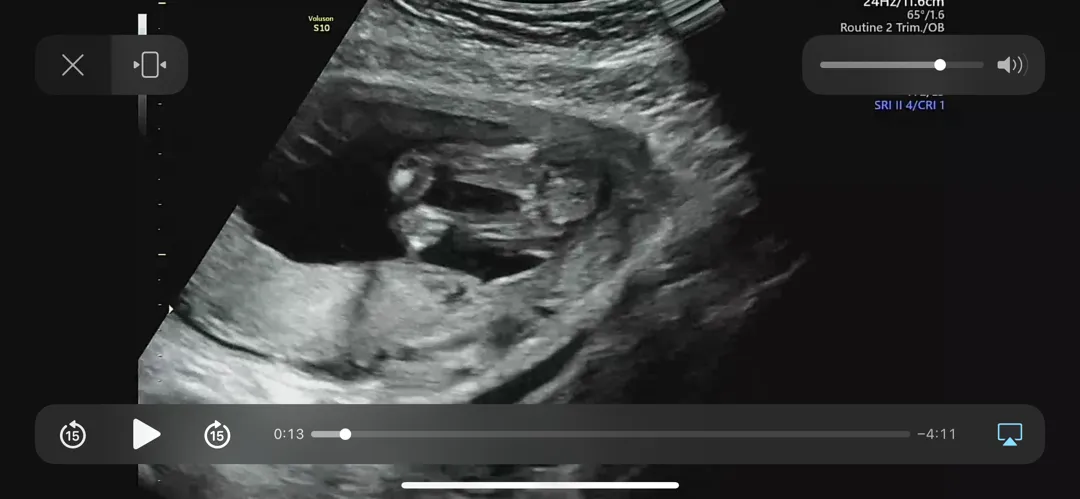 16주0일 기형아 2차검사+성별