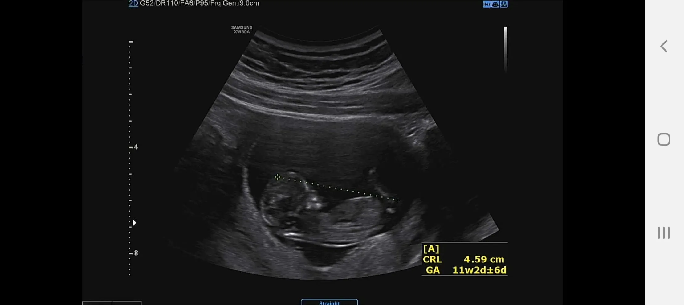 11주 5일 성별 알수 있을까요?
