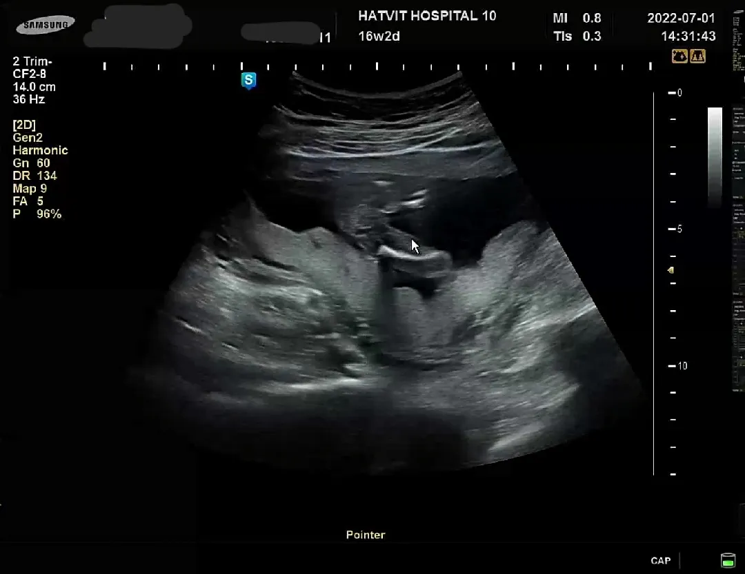 16w2d 2차기형아검사!!