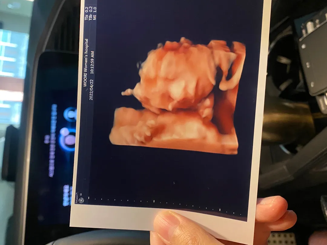 24w 임당, 정밀초음파 하고 왔어요 👶🏻