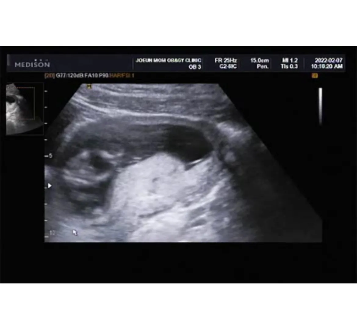 12주3일! 성별보고왔는데요!